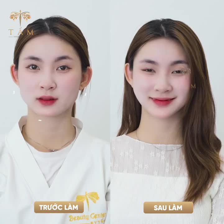 TẠM BIỆT APP BÓP MẶT - SỞ HỮU MẶT VLINE chỉ sau 30 phút