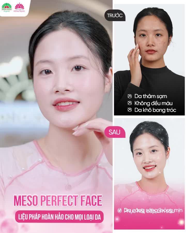 MESO PERFECT FACE: LIỆU PHÁP HOÀN HẢO CHO MỌI LOẠI DA