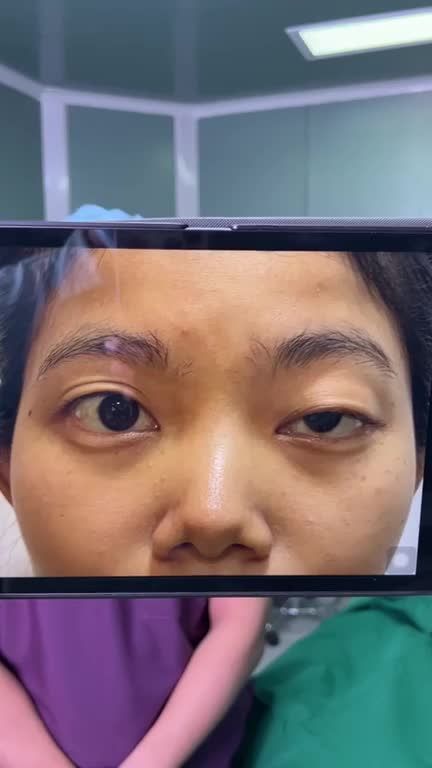 Cận cảnh KẾT QUẢ điều trị SỤP MI cho nữ sinh GEN Z mí mắt trái bị NHƯỢC CƠ bẩm sinhGIẢM 2.25 Triệu , nhắn tin ngay: https://benhvienjw.com/trogiafb