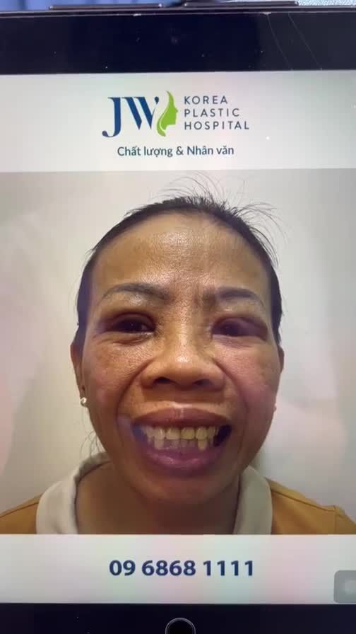 Quý cô U50 vỡ oà hạnh phúc sau PHẪU THUẬT HÀM HÔ tại JWGiảm ngay 13,5 Triệu tại đây: https://m.me/benhvienjw.vn