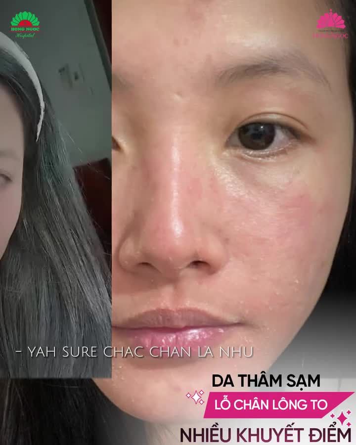 THĂNG HẠNG NHAN SẮC - NÂNG CẤP TỰ TIN SAU KHI THỰC HIỆN MESO PERFECT FACE