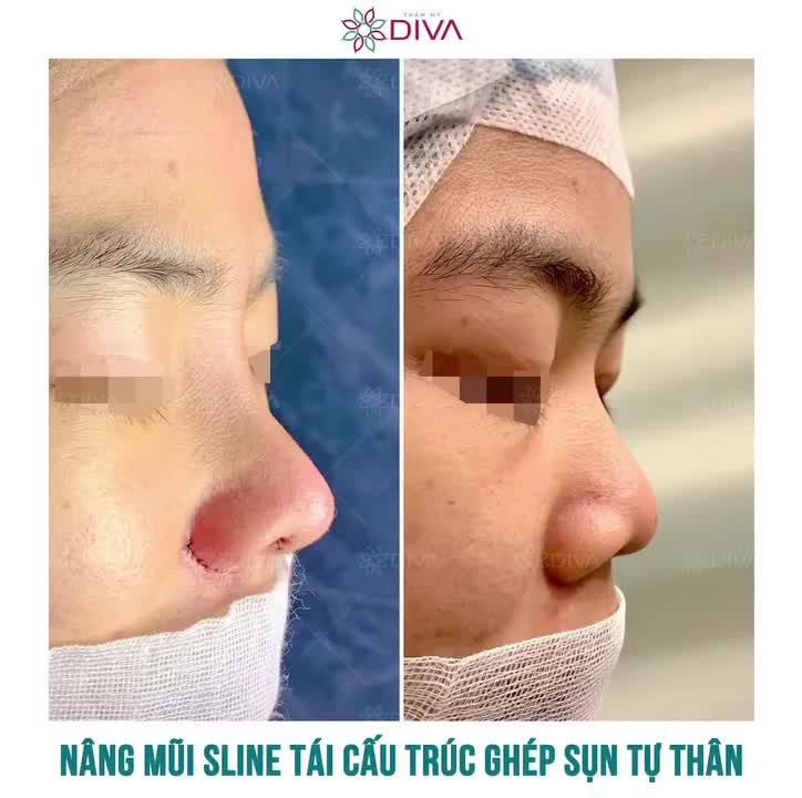 CHỈ NÂNG MŨI ĐÃ ĐỦ LỘT XÁC XINH ĐẸP TUYỆT VỜI RỒI