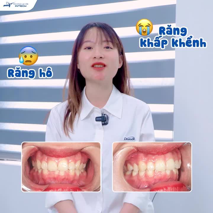 20 NĂM CHE MIỆNG KHI CHỤP ẢNH, CÔ GÁI TỰ TIN "SHOW" MỌI GÓC MẶT NHỜ NIỀNG RĂNG X-MATRIX!