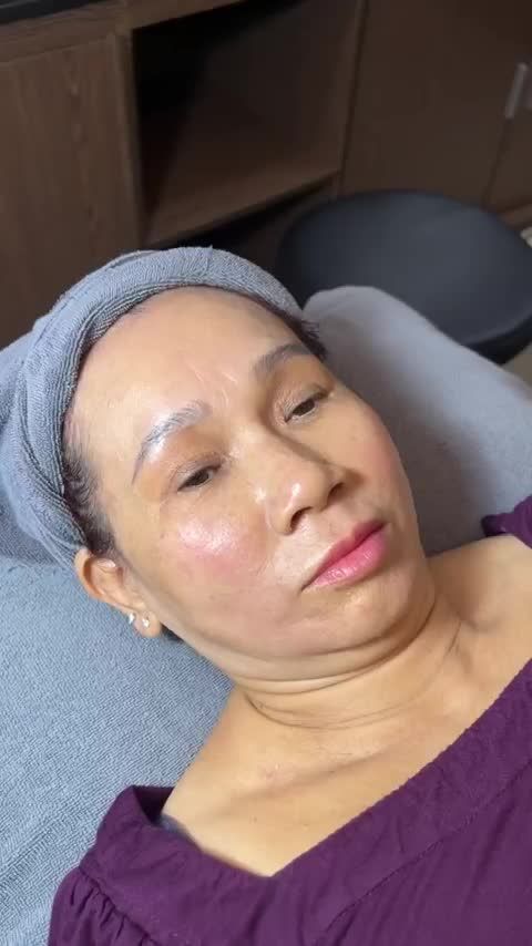 ĐỘNG TRỜI quý bà trung niên chơi lớn combo LASER TÁI TẠO DA + TIÊM MESO HA hoá cô gái 30