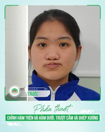 PHẪU THUẬT CHỈNH HÀM SỰ THAY ĐỔI TÍCH CỰC CỦA BN SAU PT
