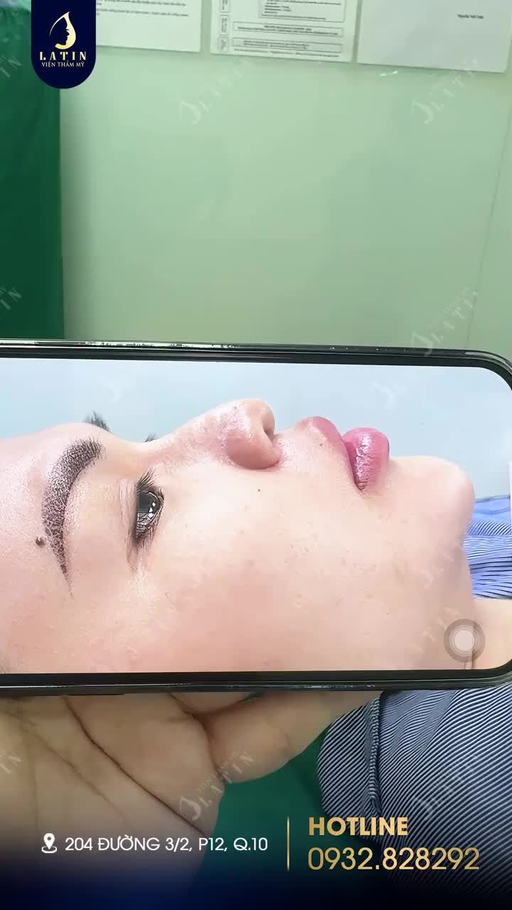 Em gái từng nâng mũi chỉ đã thay đổi dáng mũi thành công