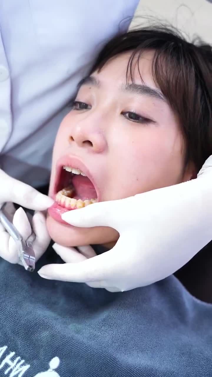THÁO MẮC CÀI SAU 2 NĂM NIỀNG RĂNG