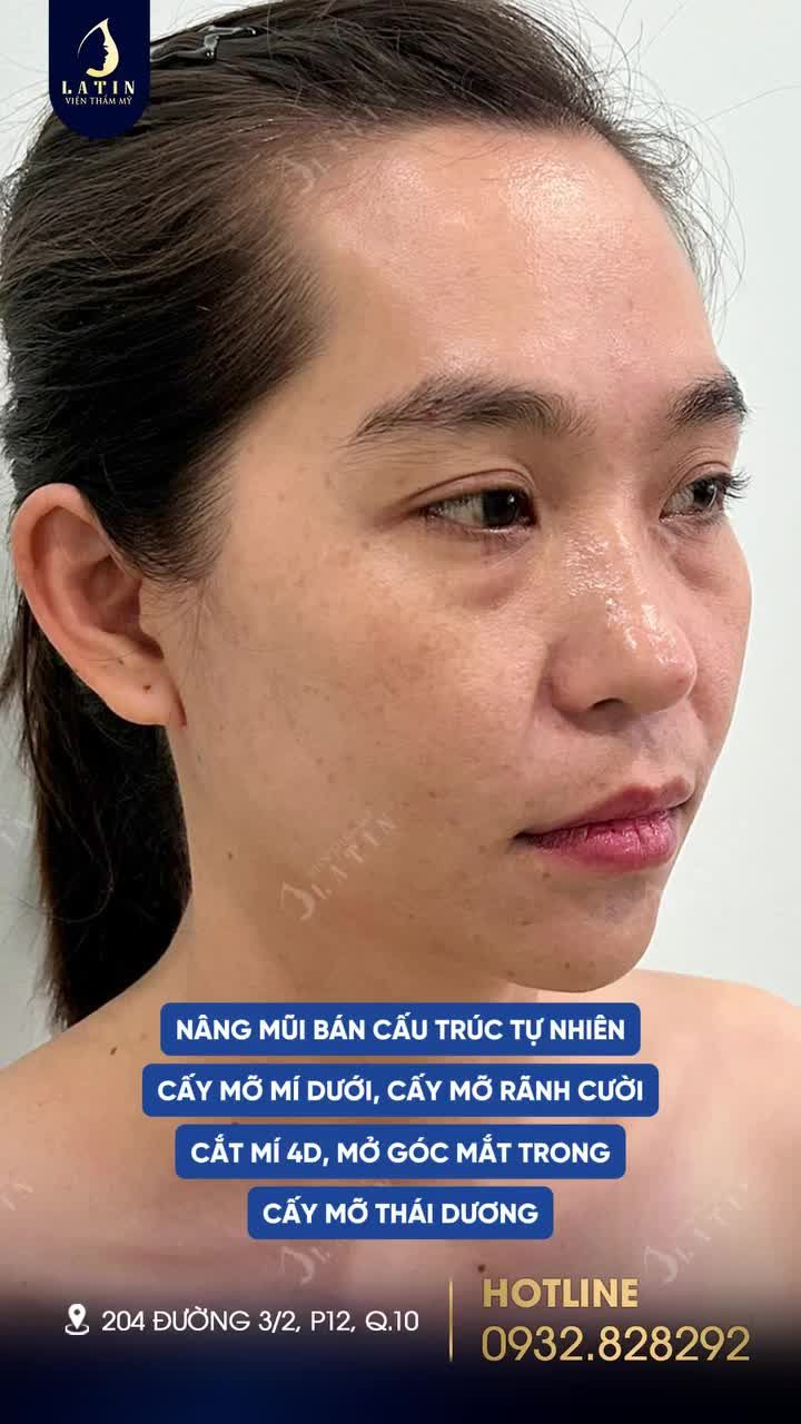 Sau 1 tháng thực hiện combo làm đẹp tại Latin, chị khách đã thay đổi như thế nào