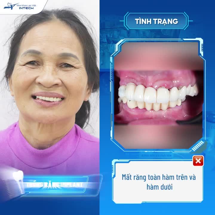 TRỒNG RĂNG IMPLANT ĐỂ THOÁT KHỎI NỖI ĐAU BIẾN CHỨNG CẦU RĂNG SỨ