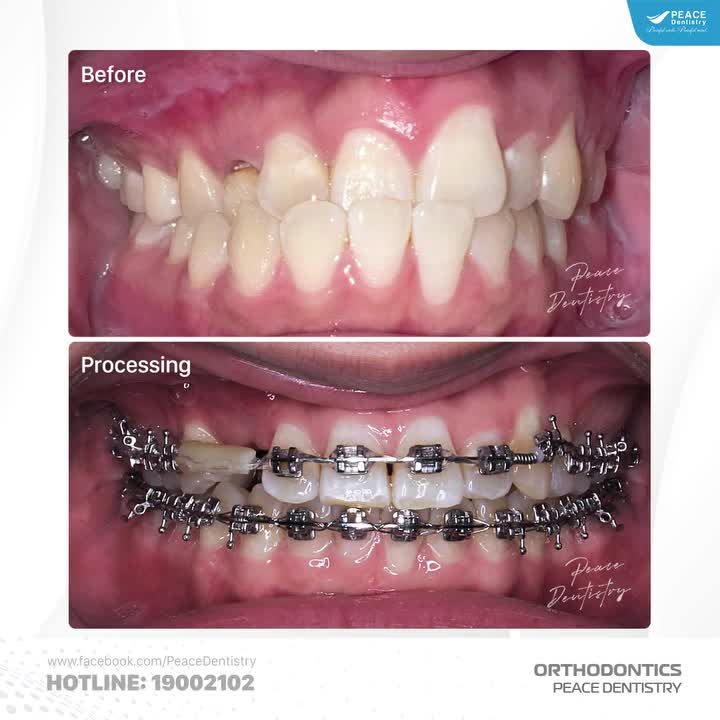 SAU 15 THÁNG VỚI CA LÂM SÀNG CHỈNH NHA PHỨC TẠP