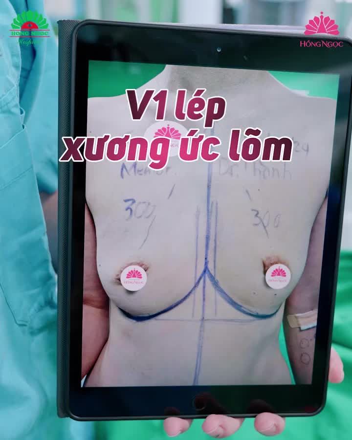 GIẢI PHÁP NÀO CHO V1 LÉP VÀ XƯƠNG ỨC LÕM???
