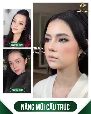 Nâng mũi cấu trúc - Phương pháp nâng mũi TOÀN DIỆN được các chuyên gia/ bác sĩ thẩm mỹ khuyên dùng.