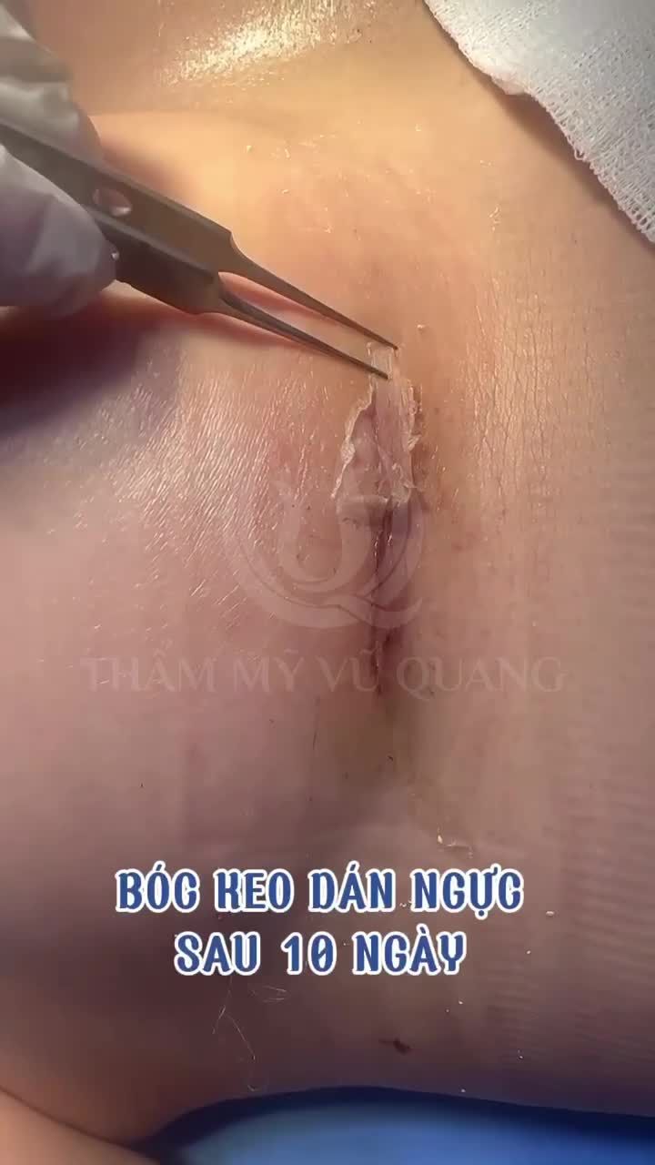 Nhiều khách hàng hỏi Bác sĩ nâng cấp vòng 1 có sẹo không? Có phải chăm sóc vết mổ không?