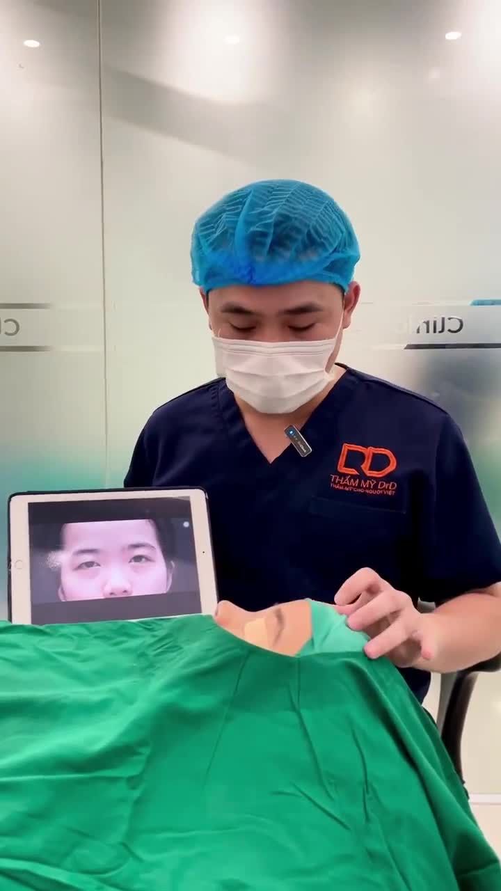 KẾT QUẢ CA NÂNG MŨI RẤT ĐẸP!