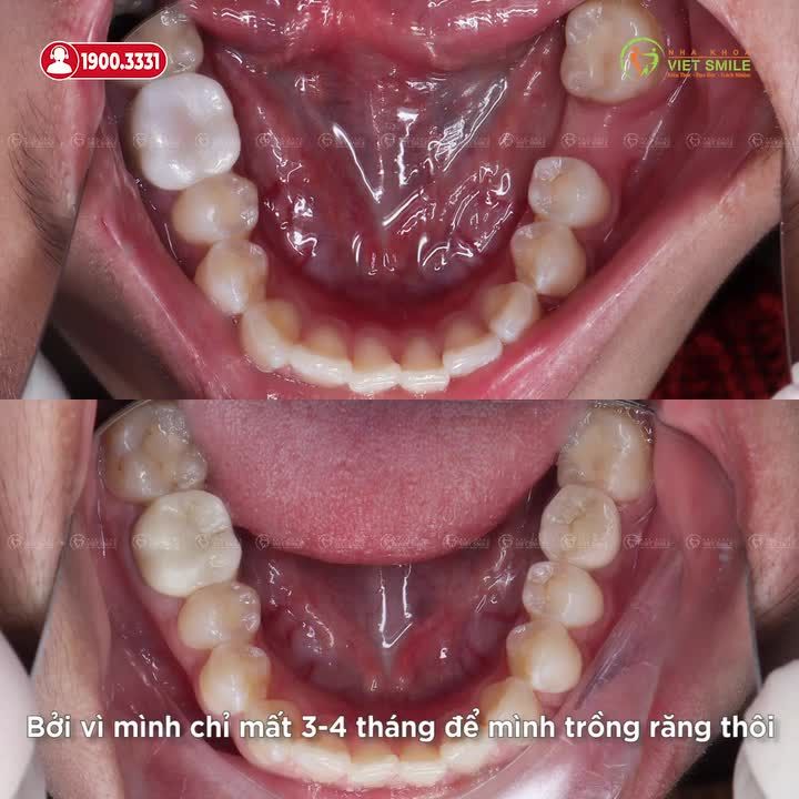 M.ẤT RĂNG HÀM - TẠI SAO NÊN TRỒNG IMPLANT SỚM?