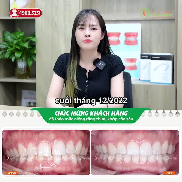 THÁO NIỀNG RĂNG THƯA CHỈ SAU 15 THÁNG