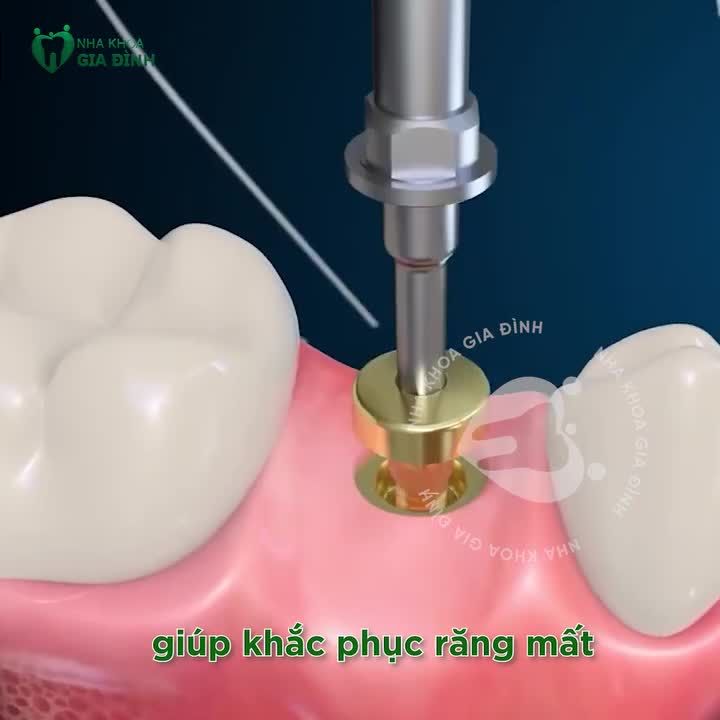 CHI PHÍ TRỒNG RĂNG IMPLANT LÀ BAO NHIÊU?