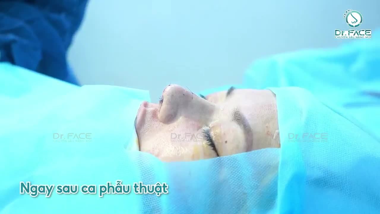 Nâng mũi sụn sườn cho chị khách U50 trẻ trung ở Mỹ