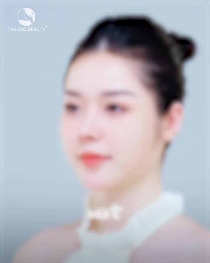 Gương mặt này sẽ thay đổi như thế nào sau nâng mũi
