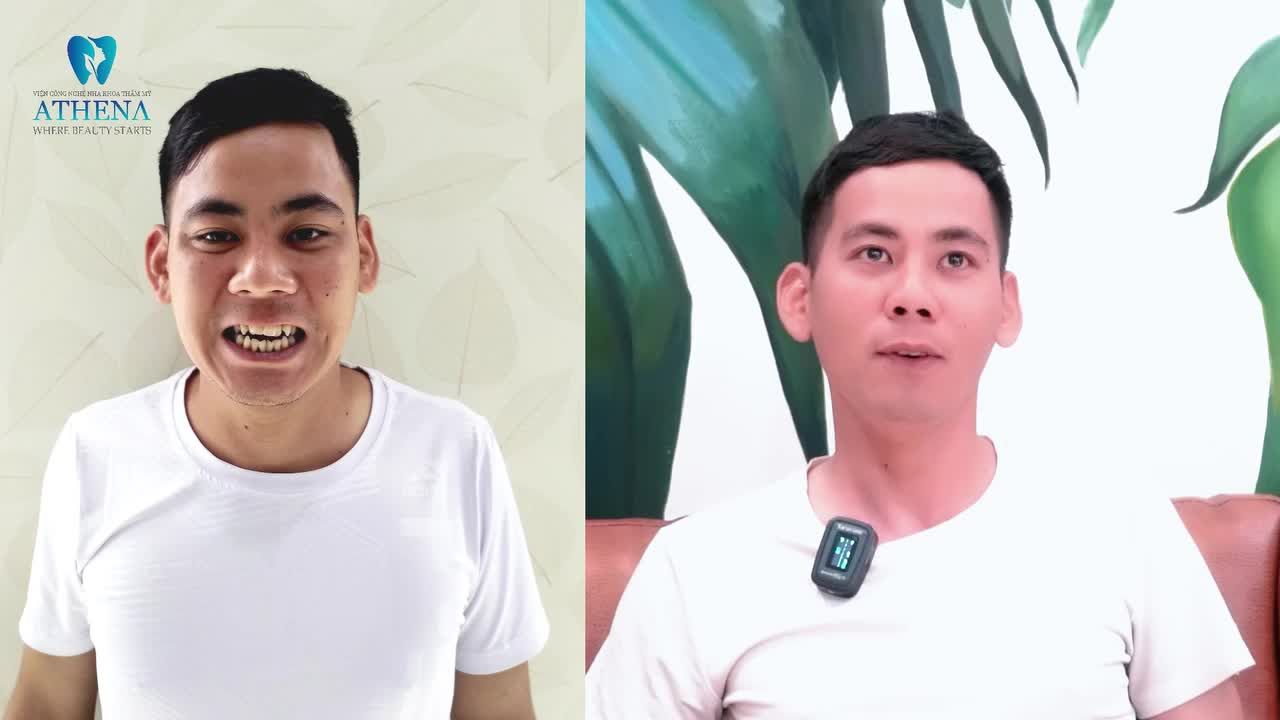 ĐIỀU TRỊ KHỚP CẮN HỞ, ĂN NHAI DỄ DÀNG HƠN VỚI MẮC CÀI KIM LOẠI