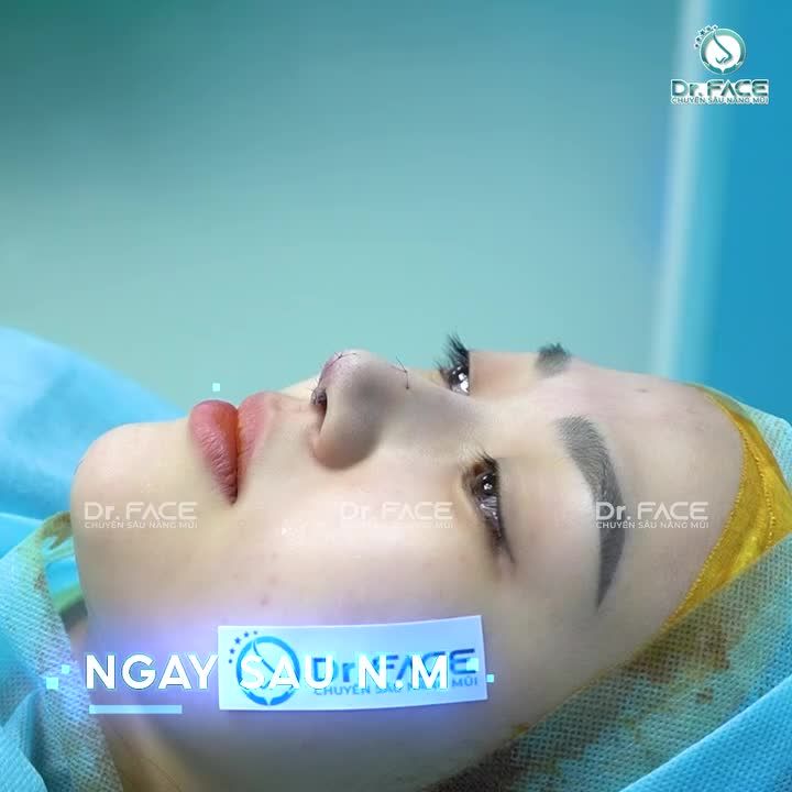 NÂNG MŨI cấu trúc “PHIÊN BẢN ĐẶC BIỆT” sẽ như thế nào?️