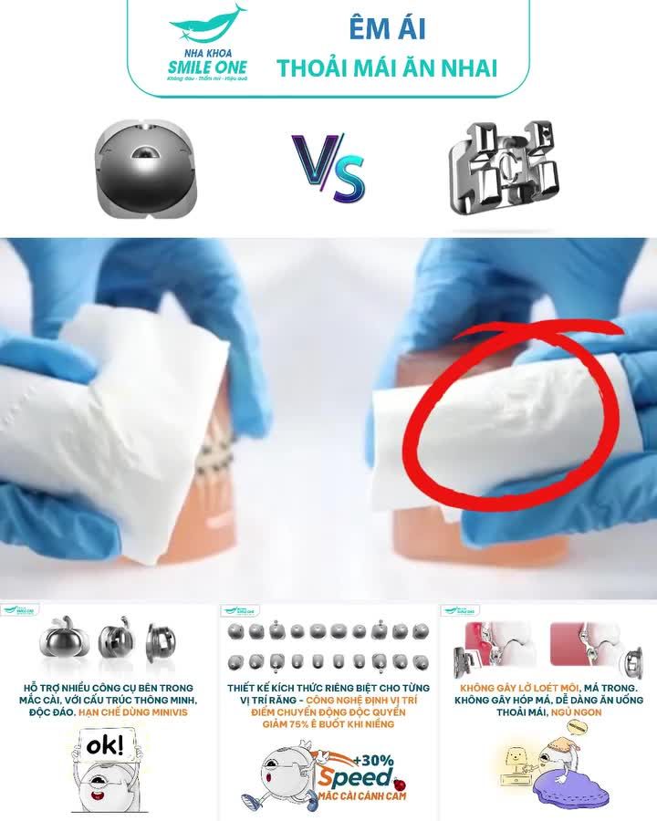 MẮC CÀI TRÒN CÁNH CAM - ĐỈNH CAO CÔNG NGHỆ NIỀNG RĂNG