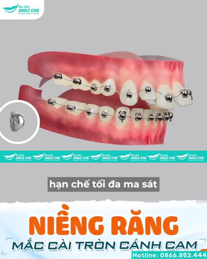 Niềng răng mắc cài cánh cam giải pháp tối ưu xóa tan mọi nỗi lo khi niềng.