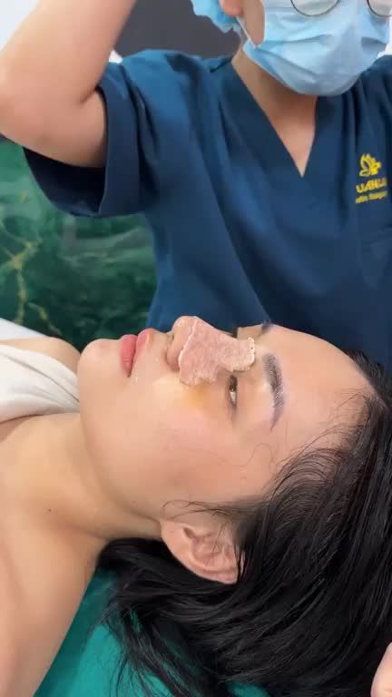 Chiếc mũi bọc sụn với giá 15 triệu sau 10 ngày tái khám!