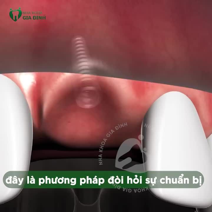 5 LƯU Ý CÔ CHÚ NHẤT ĐỊNH KHÔNG ĐƯỢC BỎ QUA TRƯỚC KHI CẤY GHÉP IMPLANT