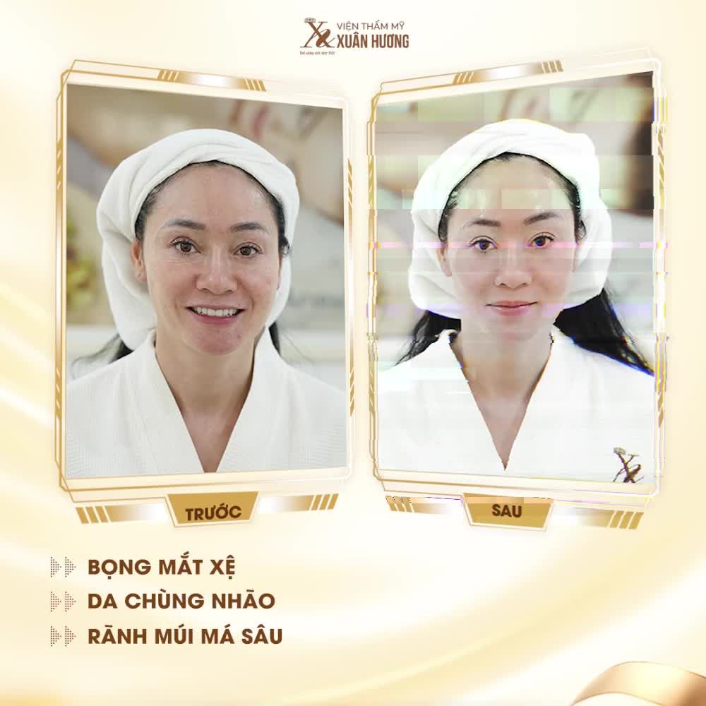 XOÁ NHĂN MẮT VỚI ULTHERA RF GIÚP BẠN TIẾT KIỆM ĐƯỢC 1 NĂM SỬ DỤNG SẢN PHẨM BÔI NGOÀI DA