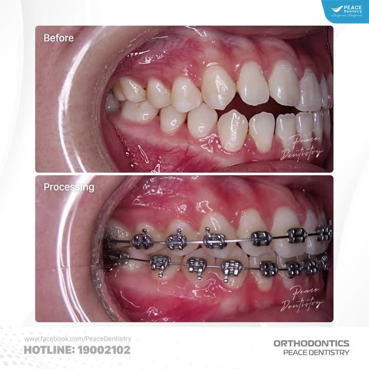 CẮN HỞ VÙNG RĂNG TRƯỚC VÀ SỰ THAY ĐỔI SAU 5 THÁNG NIỀNG RĂNG MẮC CÀI KIM LOẠI
