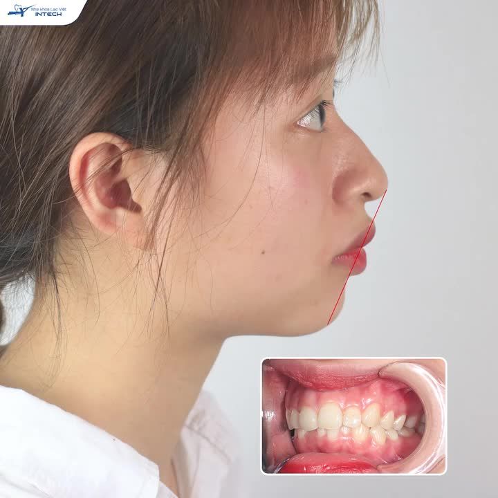 NIỀNG RĂNG X-MATRIX XÓA BỎ HÔ VÀ CƯỜI HỞ LỢI, NỮ KHÁCH HÀNG HẠNH PHÚC VÌ KẾT QUẢ NIỀNG RĂNG ĐẸP HƠN MONG ĐỢI!