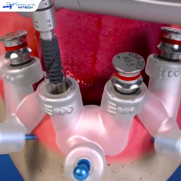CHUYÊN GIA CHIA SẺ KIẾN THỨC: CÔNG NGHỆ PHẪU THUẬT USI KHÁC GÌ SO VỚI CÔNG NGHỆ PHẪU THUẬT IMPLANT CŨ?