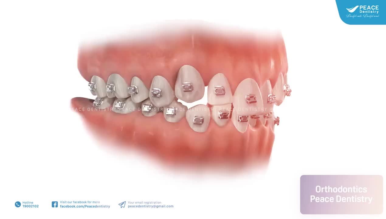 NIỀNG RĂNG MẮC CÀI TỰ BUỘC | ENGLISH BELOW|