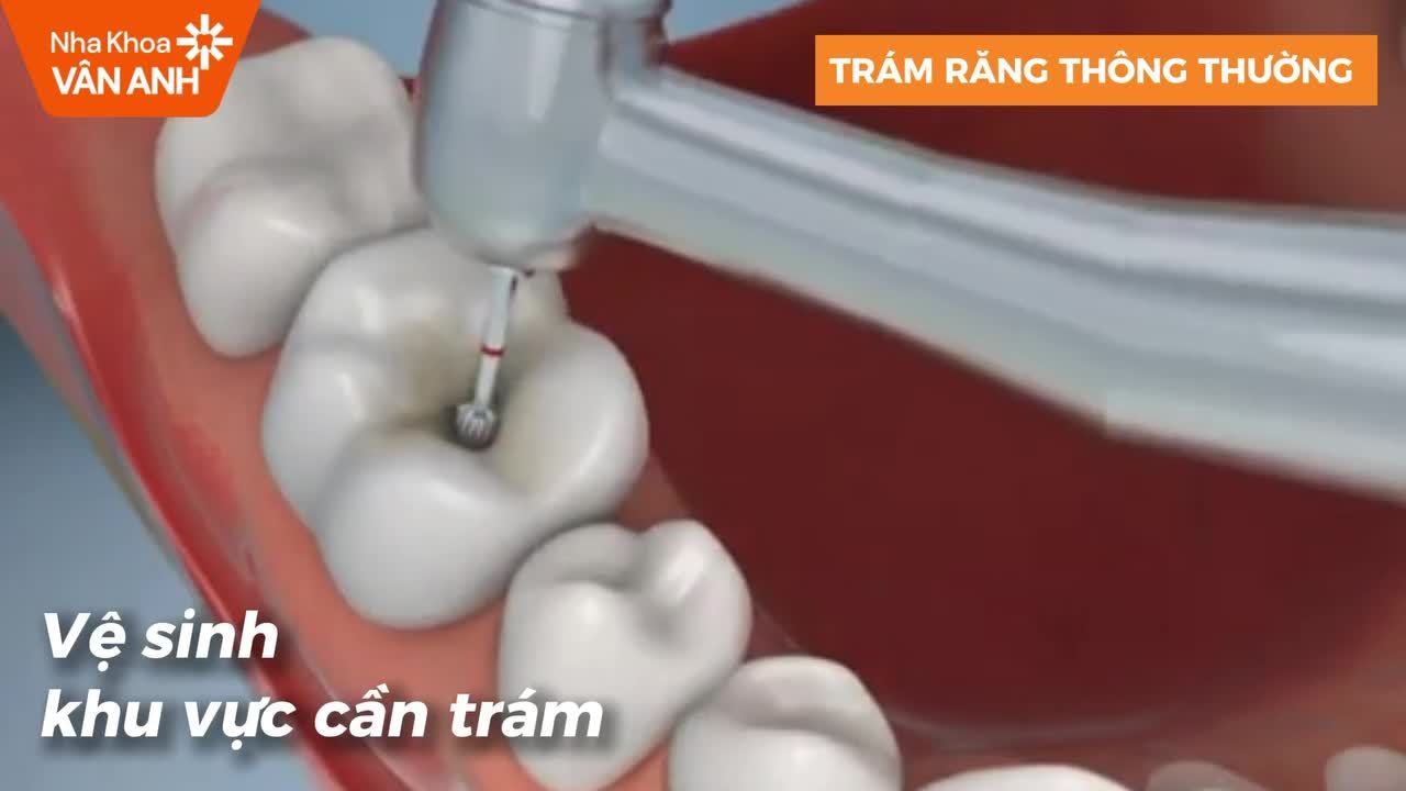 CHỌN INLAY/ONLAY HAY PHƯƠNG PHÁP HÀN - TRÁM RĂNG TRUYỀN THỐNG CHO RĂNG SÂU, RĂNG VỠ?