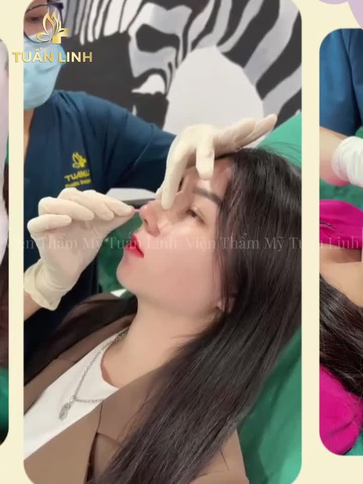 NÂNG MŨI BỌC SỤN TỰ THÂN CHỈ CÒN 15TR TRỌN GÓI!!
