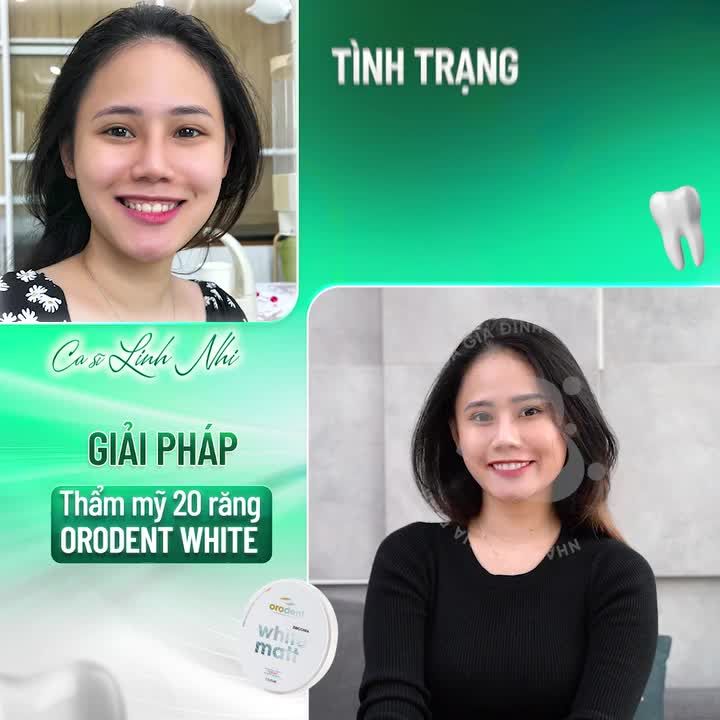 TOP 5 TÁI SINH NỤ CƯỜI VỚI RĂNG SỨ ORODENT