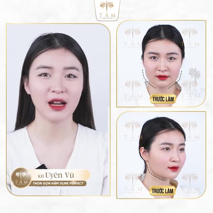 NHỮNG MÀN LỘT XÁC CỦA KHÁCH HÀNG SAU LIỆU TRÌNH THON GỌN HÀM TẠI TẤM