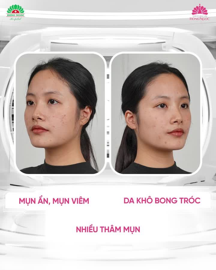 TẠM BIỆT DA KHÔ BONG TRÓC - DỨT ĐIỂM THÂM MỤN VỚI MESO PERFECT FACE
