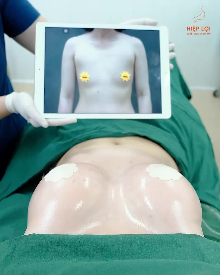 Nâng ngực vòng 1 - Dòng túi Motiva Ergonomix