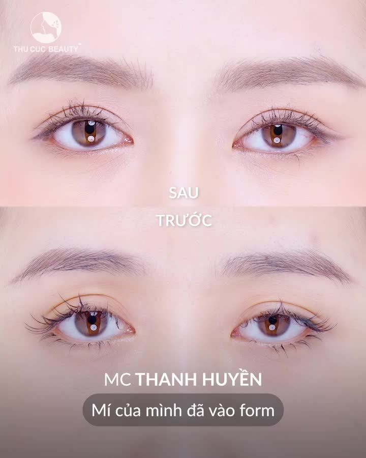 Sở hữu đôi mắt vạn người mê là khi đến với BVTM Thu Cúc
