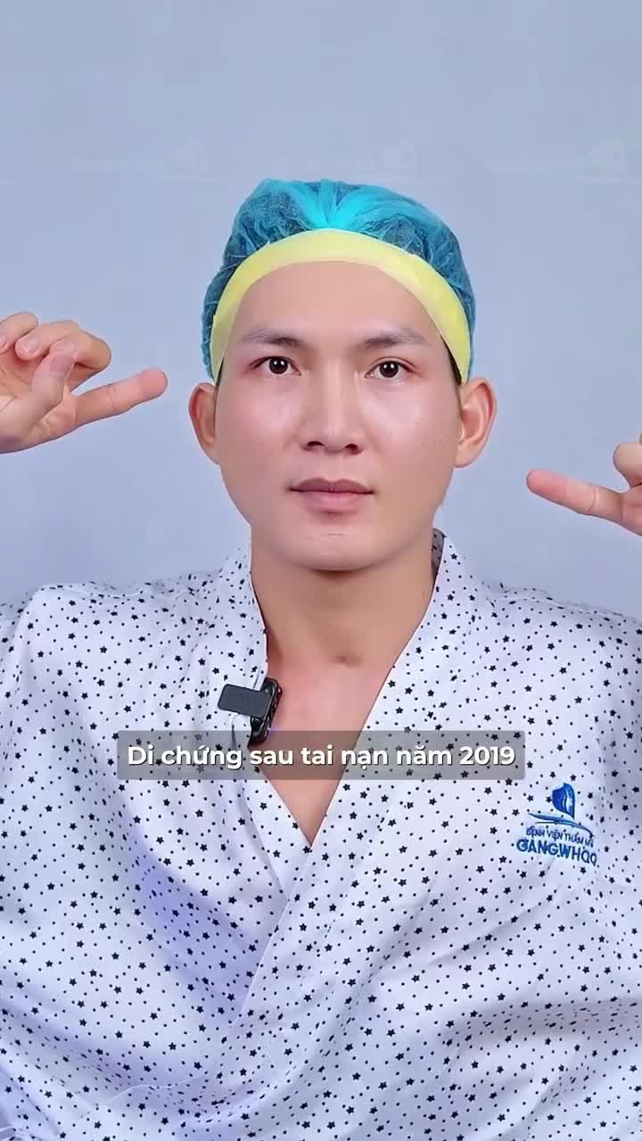 Chia sẻ thực tế của anh khách hàng sau khi thực hiện dịch vụ gọt hàm tại bệnh viện Gangwhoo.