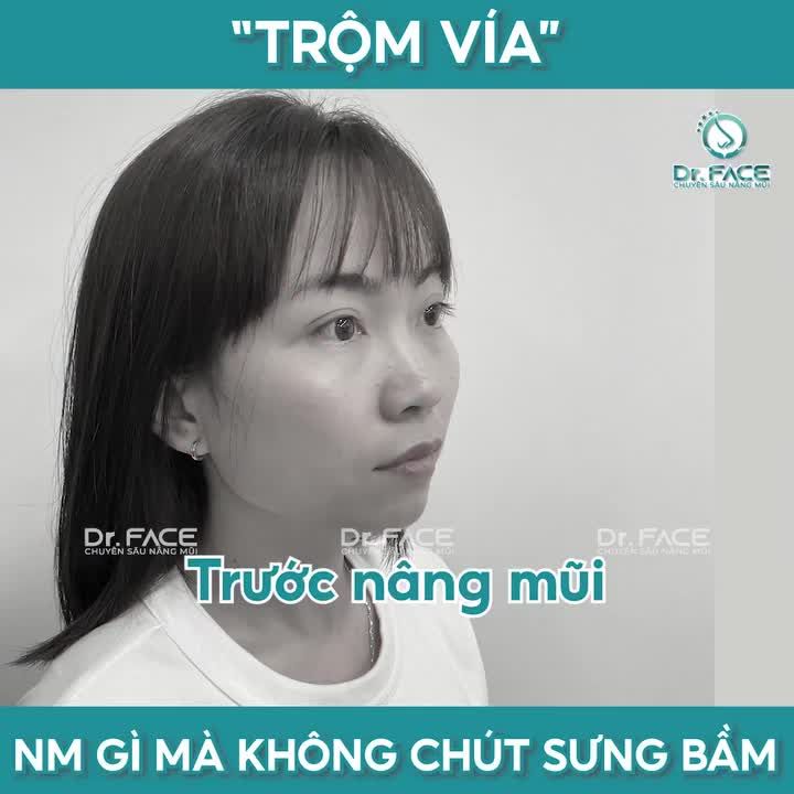 “TRỘM VÍA” NÂNG MŨI GÌ MÀ KHÔNG CHÚT SƯNG BẦM