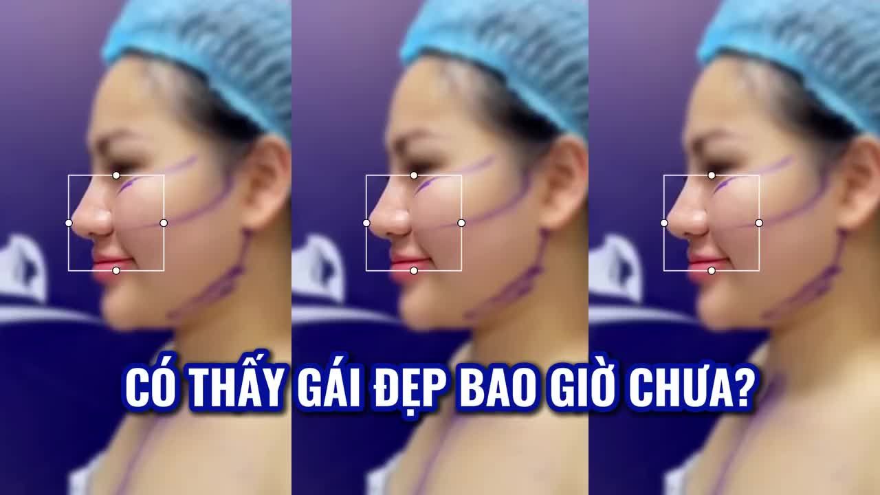 Tại bệnh viện Gangwhoo mỗi ngày chúng tôi tiếp nhận rất nhiều ca hạ gò má, phần nào giúp các chị em có thể tự tin sải bước cùng gương mặt xinh đẹp ưa nhìn.