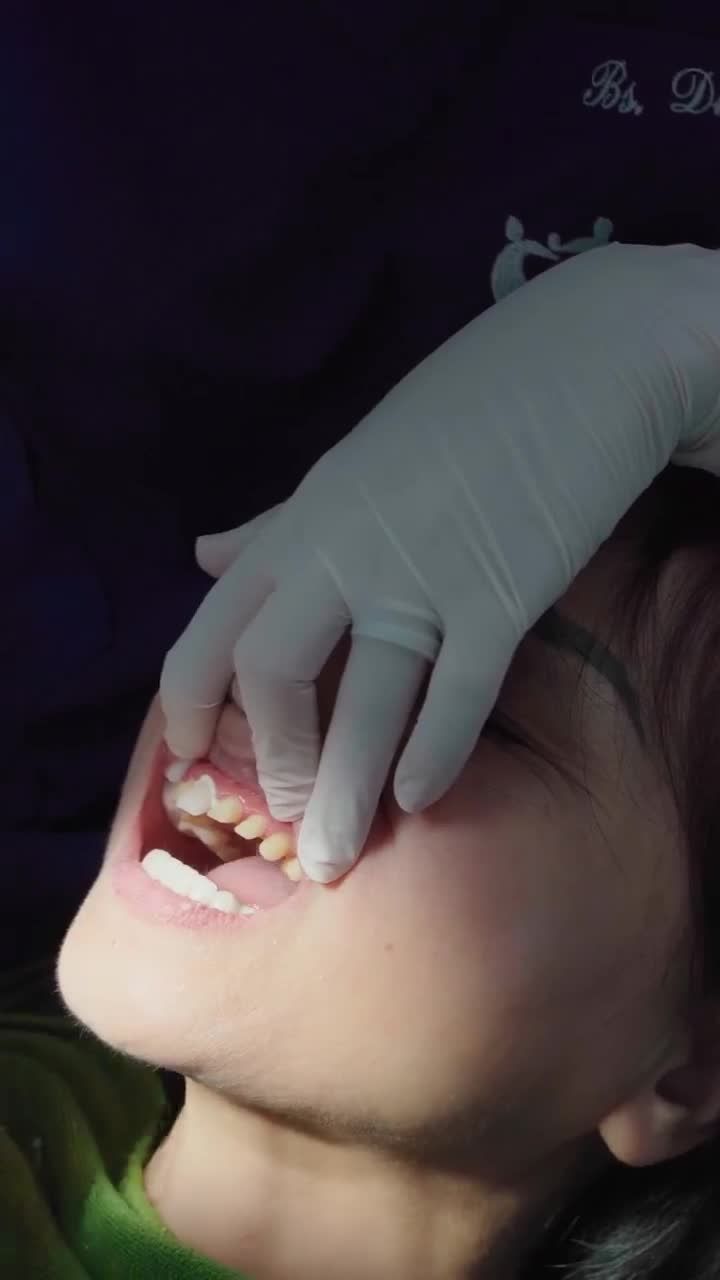 QUÁ TRÌNH BÁC SĨ VŨ BÍCH DIỆP GẮN 19 ĐƠN VỊ RĂNG SỨ CHO MỘT NỮ KHÁCH HÀNG