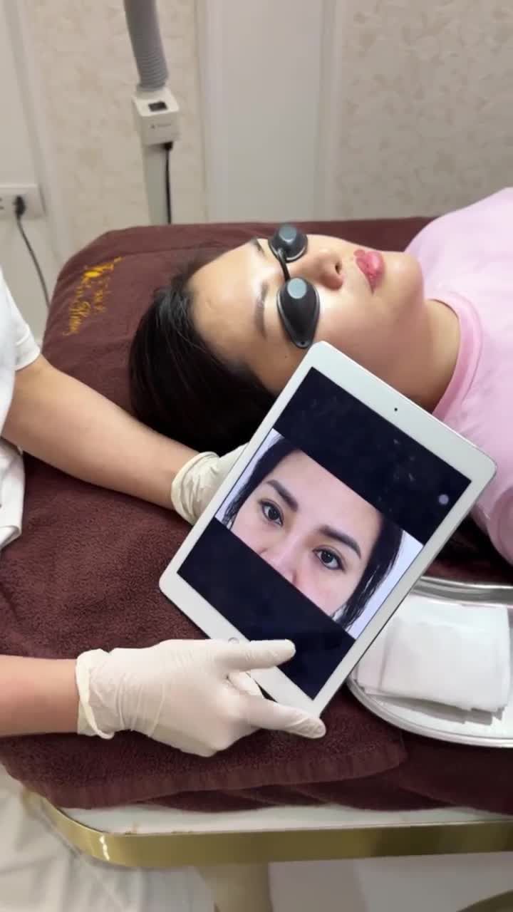 Hút mực xăm mày trổ xanh cho khách hàng buổi 2 với công nghệ Melas Picosure