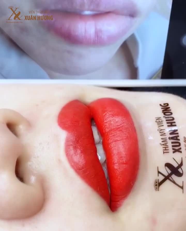 Cùng là 1 đôi môi mà tại sao trước & sau khi đến VTM Xuân Hương lại khác vậy nhỉ?