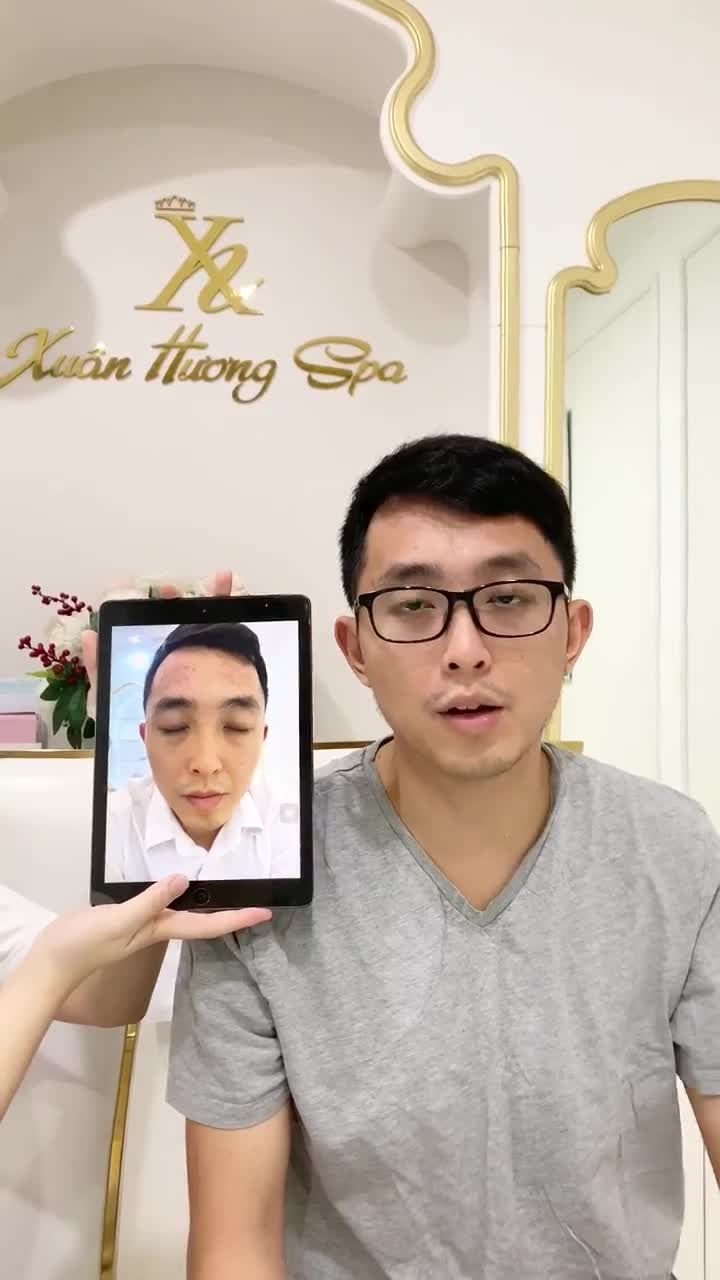 Khách hàng nam chia sẻ sau liệu trình trị mụn tại VTM Xuân Hương