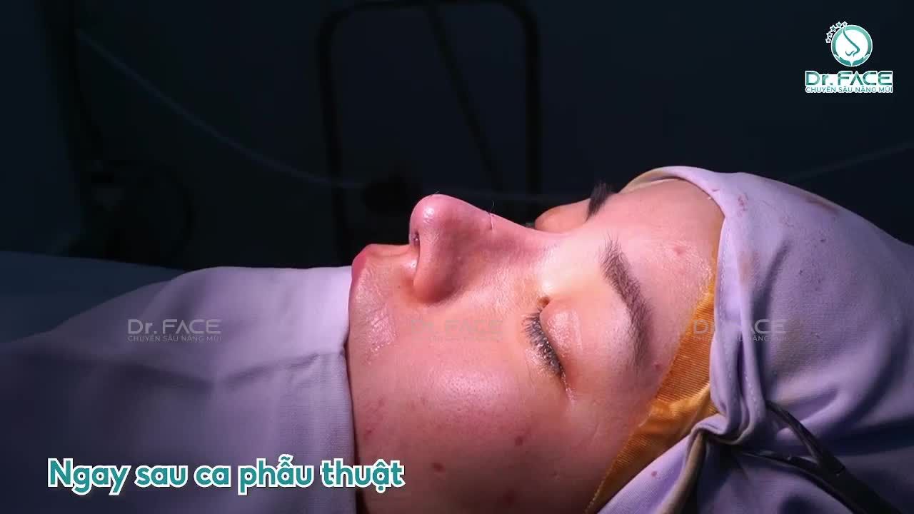 Làm Mới Chiếc Mũi Gồ, To Bè Cho Cô Bạn Đến Từ Nhật