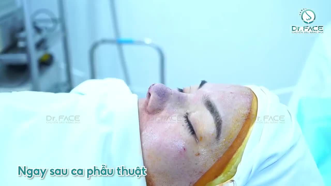 Combo nâng mũi sụn sườn + cấy mỡ 3 vùng cho chị khách U50